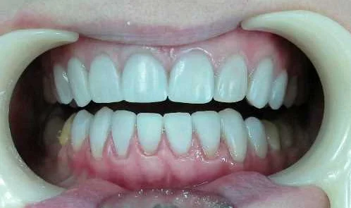 Последствия чрезмерного использования губной помады