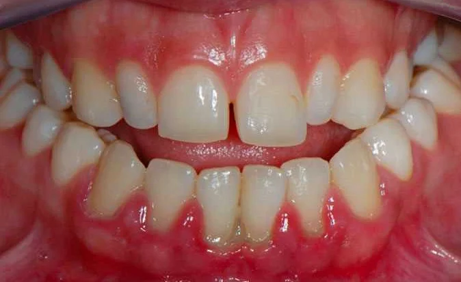 Разрушение зубов и пульпит