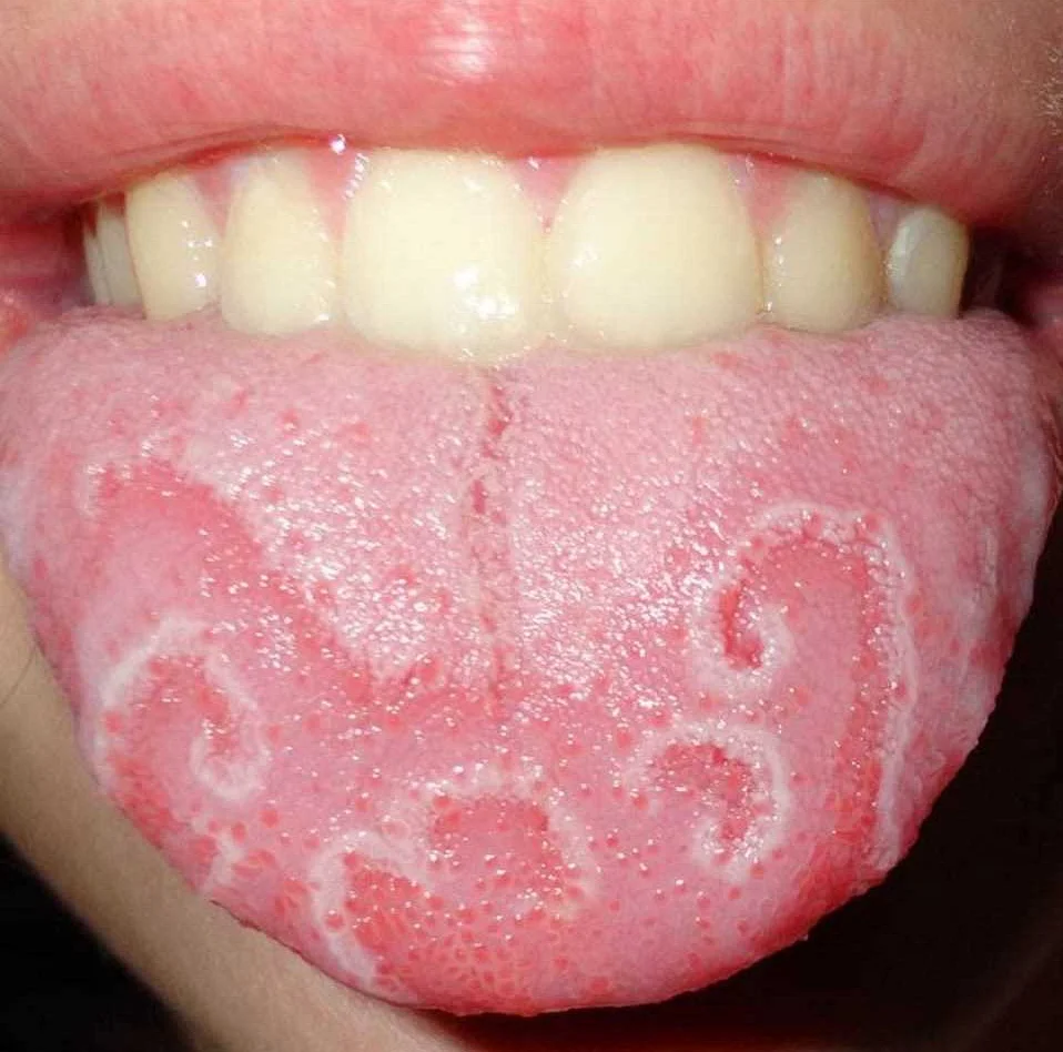 Признаки и симптомы патологий полости рта