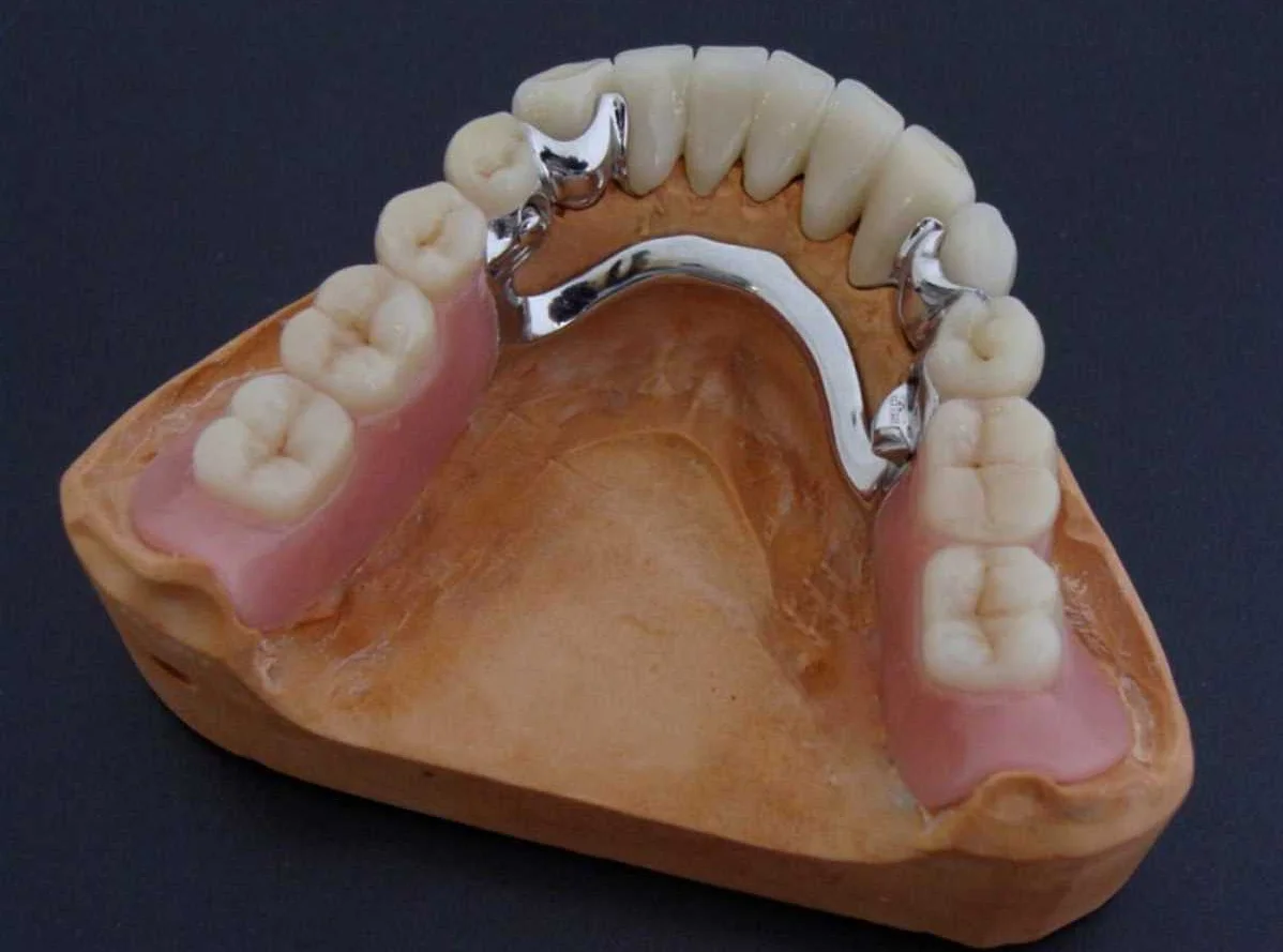 Особенности протезирования переднего зуба