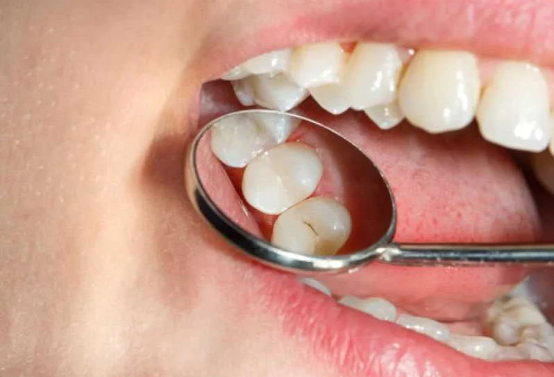 Как сохранить здоровье зубов и предотвратить развитие кариеса