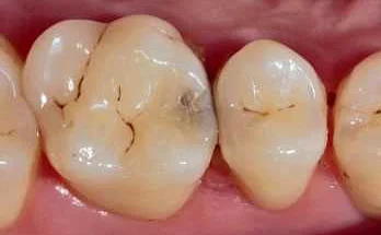 Рекомендации по уходу за зубами для предотвращения кариеса