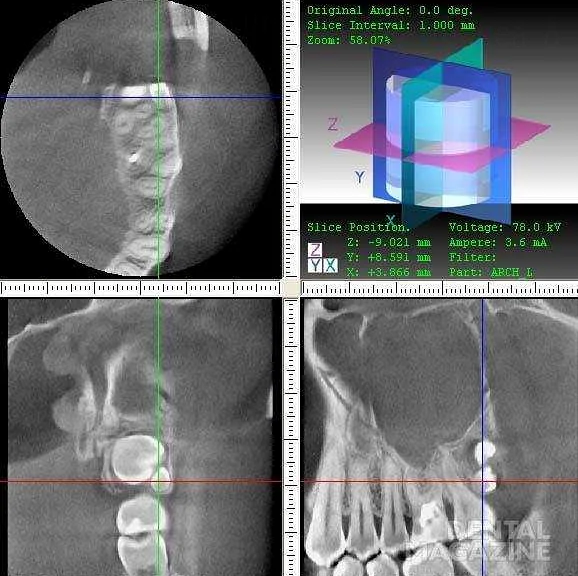Компьютерная томография при планировании ортодонтического лечения