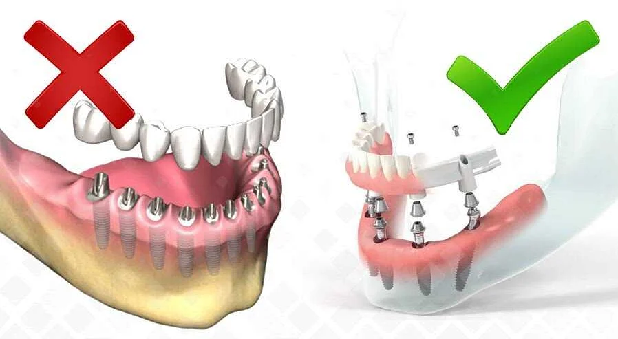Миф #3: Зубные имплантаты недоступны по цене для всех