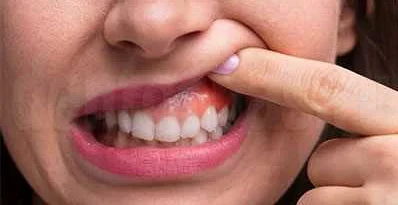 Как лечение травмы зубов может повлиять на способность жевать