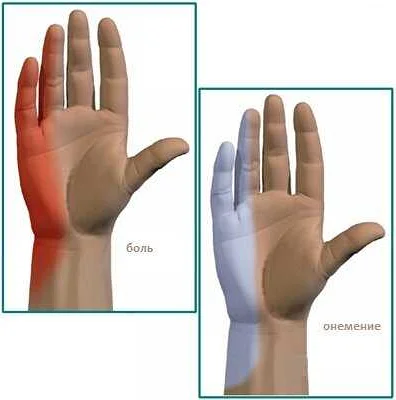 Онемение пальца руки: остеохондроз может быть причиной