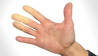 Стресс и перенапряжение могут вызвать онемение пальца руки