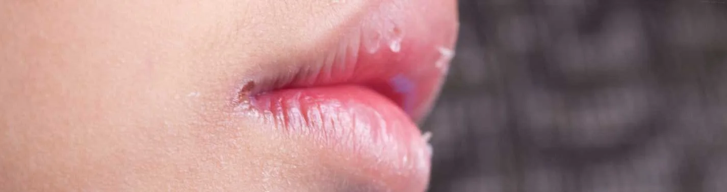 Какие лечебные мази можно использовать для снятия неприятных ощущений на губах?