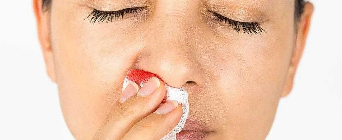Какие симптомы сопутствуют носовым кровотечениям?