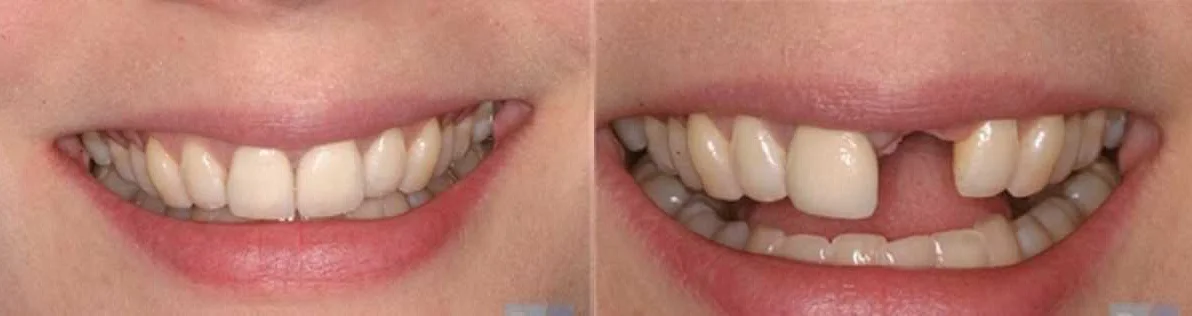 Причины для удаления зуба