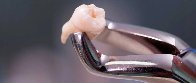 Миф: удаление зуба приводит к бесплодию