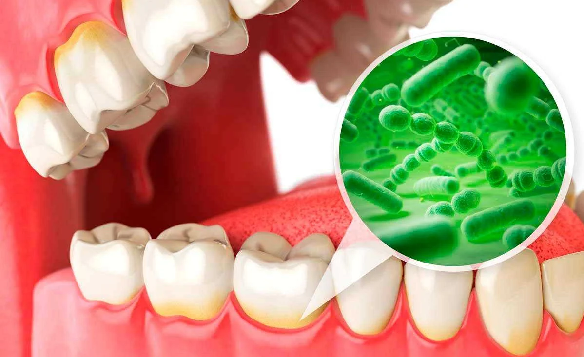 Профилактика поражения зубов при заболеваниях желудочно-кишечного тракта