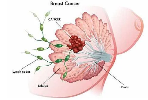 Причины и факторы риска развития рака молочной железы