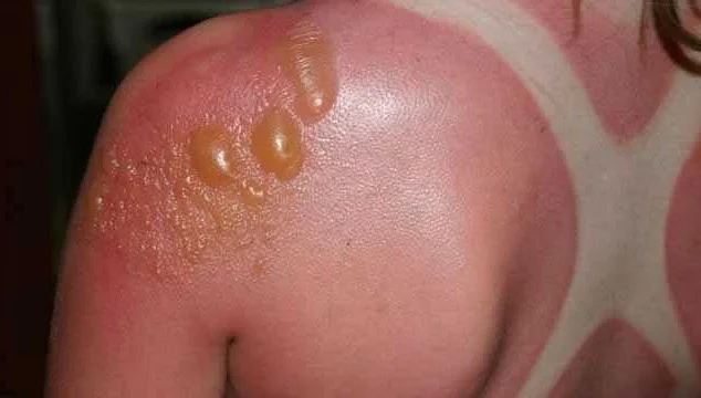 Повреждение кожи от солнечного излучения