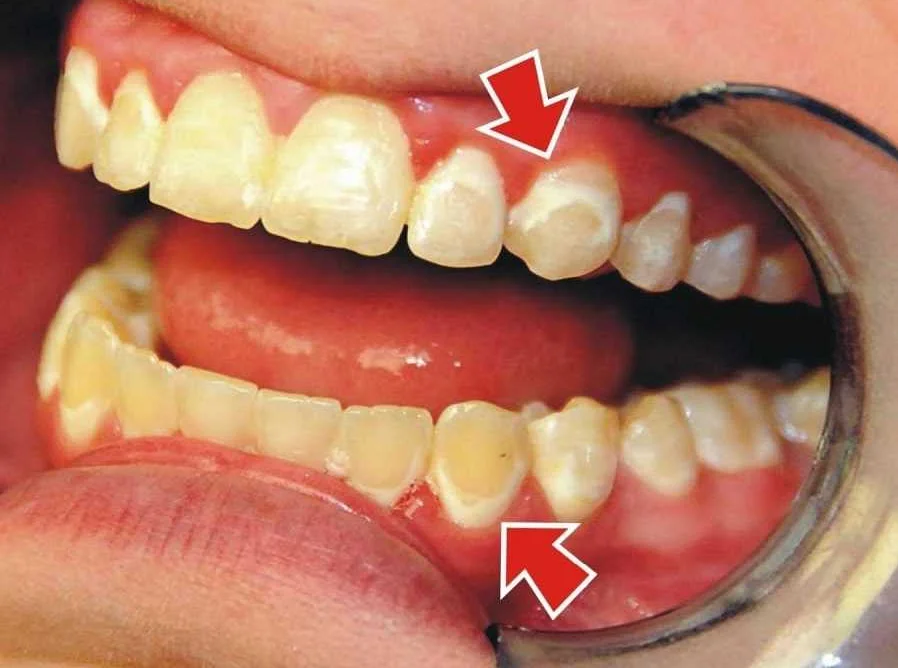 Опасности неправильной чистки зубов: как избежать проблем