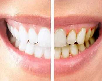 Определение зубной эмали