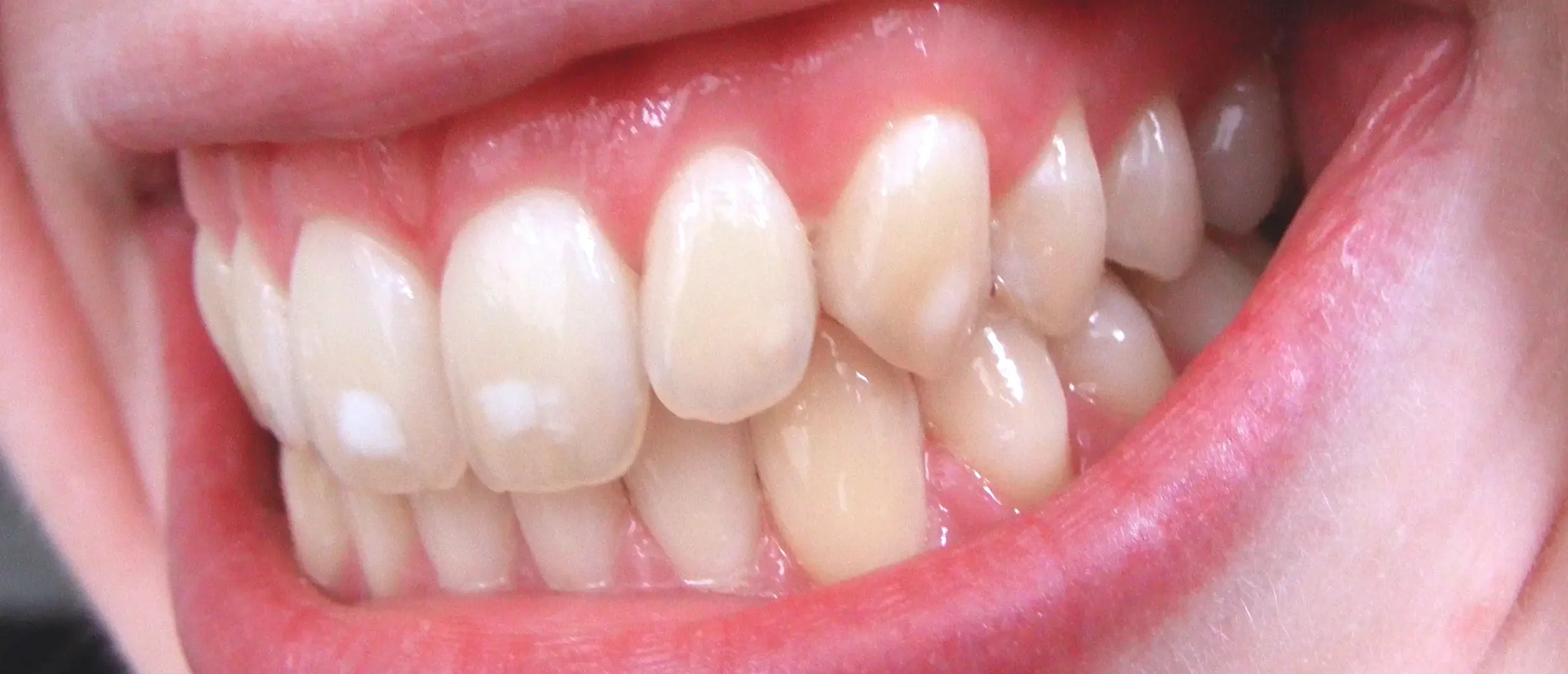 Что такое зубная эмаль?