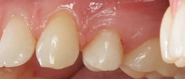 Роль правильного питания для зубной эмали