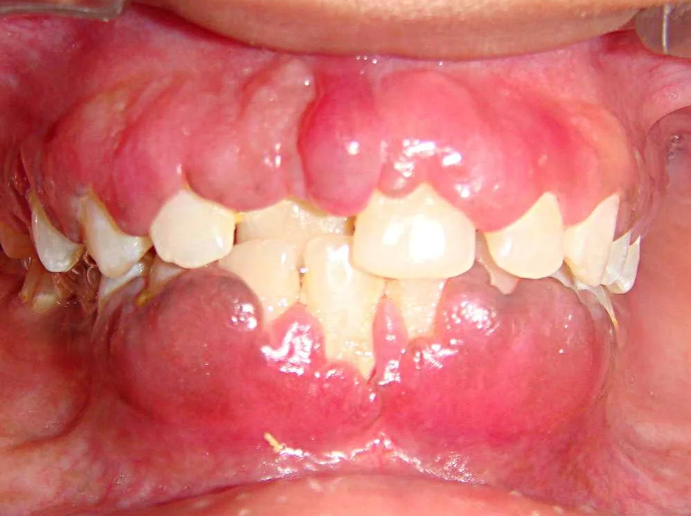 Влияние ортодонтии на десневую ткань и ее здоровье в долгосрочной перспективе