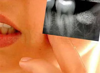 Осложнения стоматологических операций и их последствия