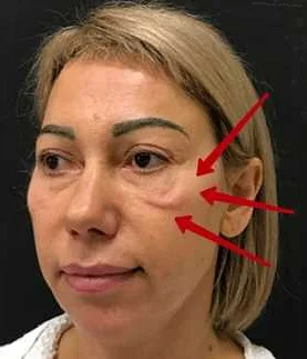 Уход за кожей вокруг глаз после удаления мешков: рекомендации специалистов