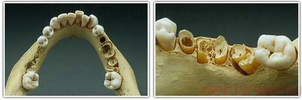 Профилактика остеопороза для здоровья зубов и костей