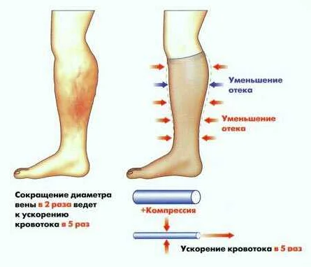 Лечение отеков ног: принципы