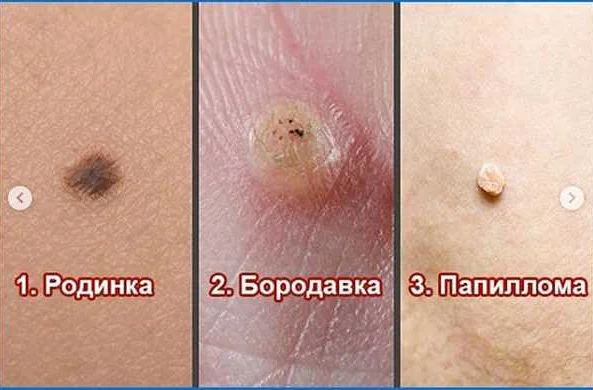 Основные методы диагностики папиллом на коже