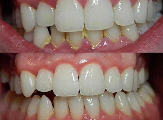 Роль зубной пленки в развитии пародонтоза