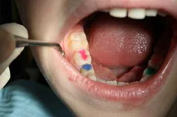 Процедура пломбирования молочных зубов у детей