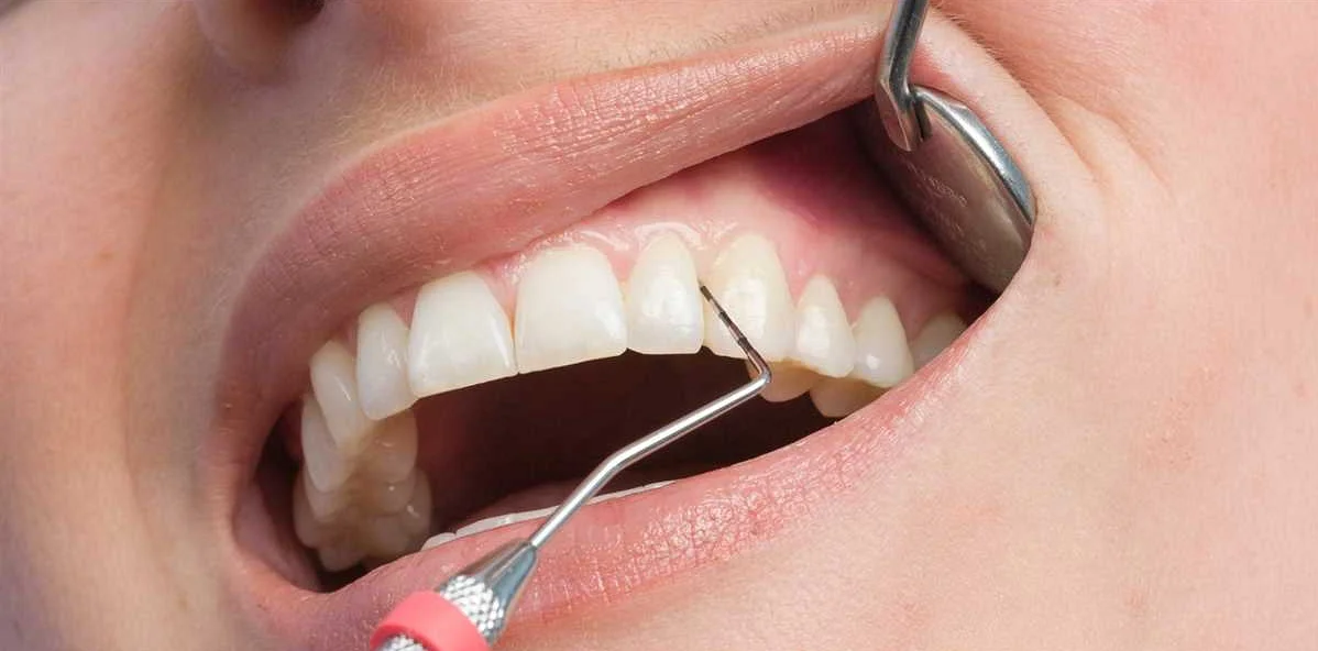 Важность систематических чисток зубов дома после посещения стоматолога