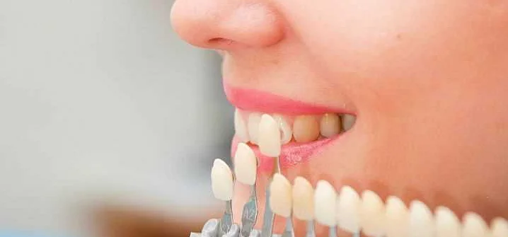 Улучшение внешнего вида зубов