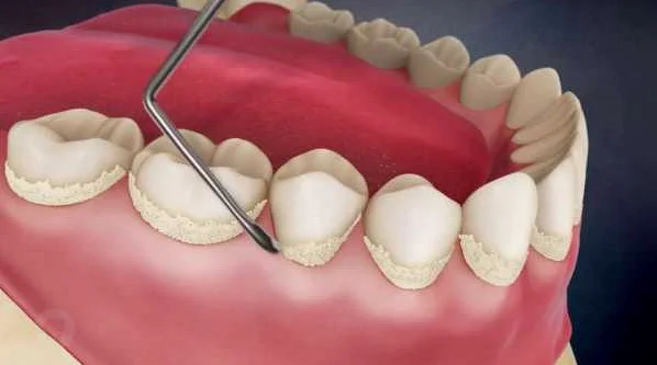 Регулярные посещения стоматолога - залог здоровья и профилактика пародонтоза