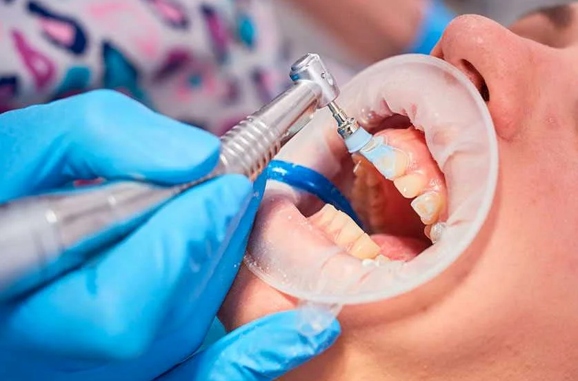 Предотвращение кариеса и пародонтита - ключевая задача профилактической чистки зубов