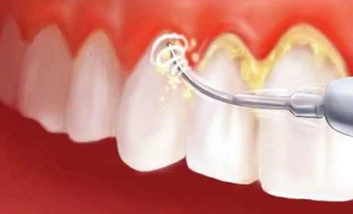 Профилактическая чистка зубов у стоматолога - инвестиция в здоровье и красоту ротовой полости