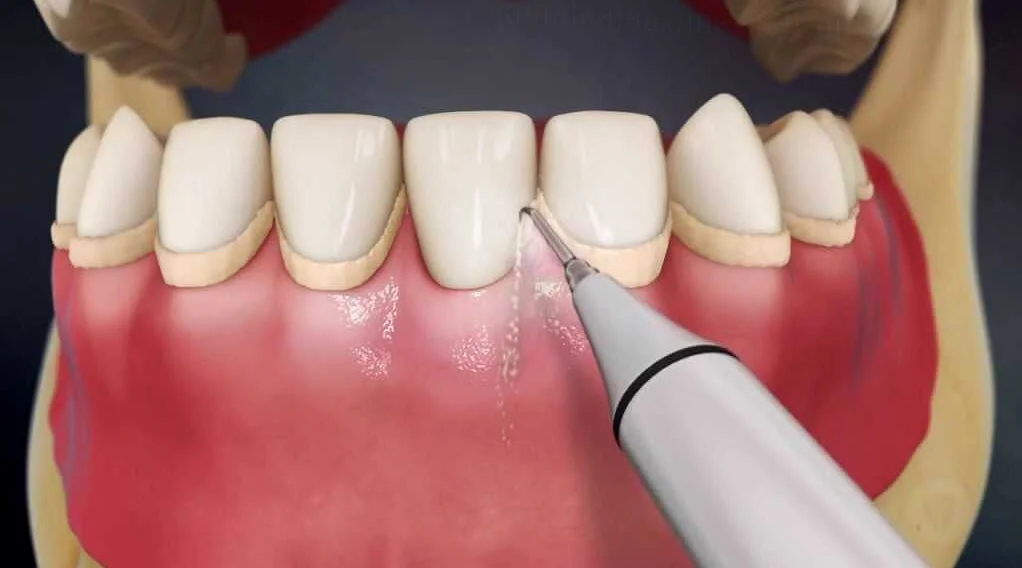 Почему возникает зубной камень и как его предотвратить?