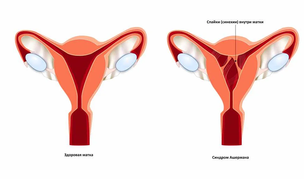 Синдром поликистозных яичников и задержка менструации