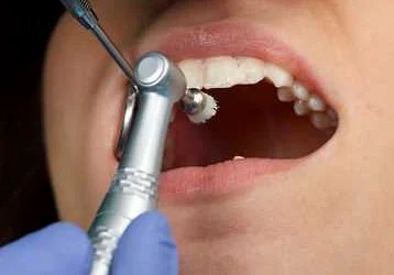 Промежуточные чистки зубных пространств укрепляют зубы