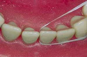 Польза зубной нити: уход за полостью рта