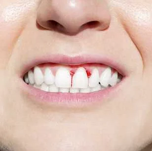 Последствия неправильного лечения зубных травм
