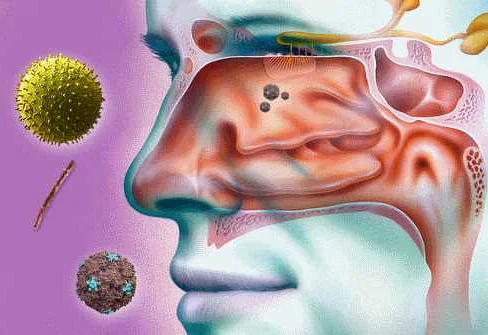 Медикаментозные методы лечения аллергии: польза и вред для слизистой носа
