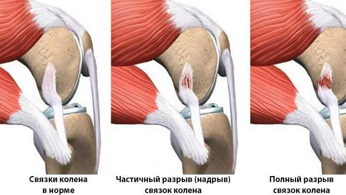 Методики профилактики повреждений связок колена