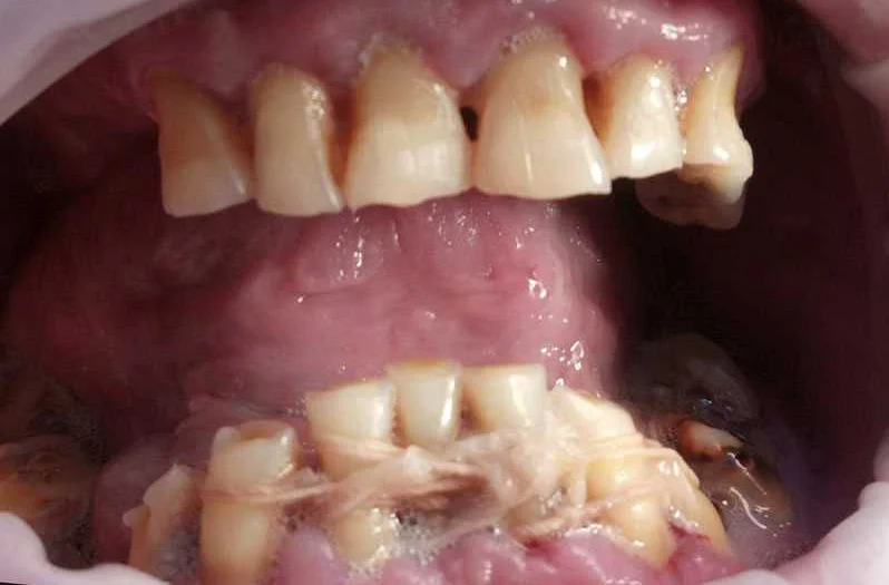 Преимущества инивизилин в ортодонтии