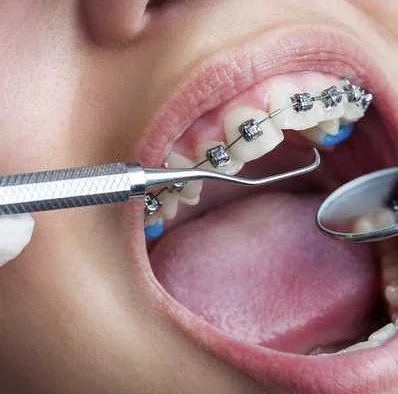 Как добиться ровных зубов без выбора заметных нагрузок?