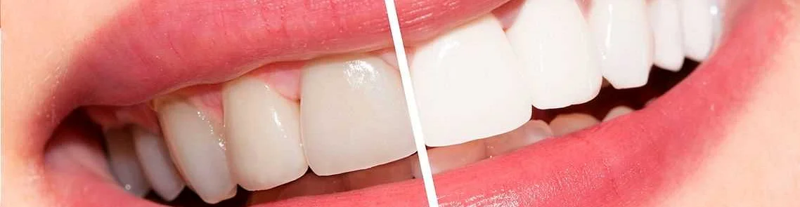 Преимущества и результаты профессионального отбеливания зубов