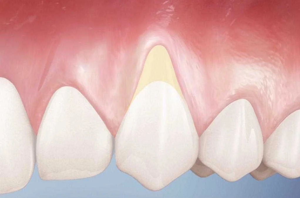 Профилактика пародонтоза для сохранения здоровья зубов