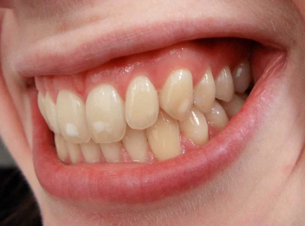 Причины разрушения эмали зубов при хроническом гастрите