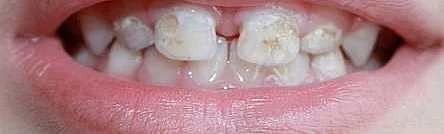 Рекомендации для поддержания здоровья полости рта и эмали зубов при хроническом гастрите