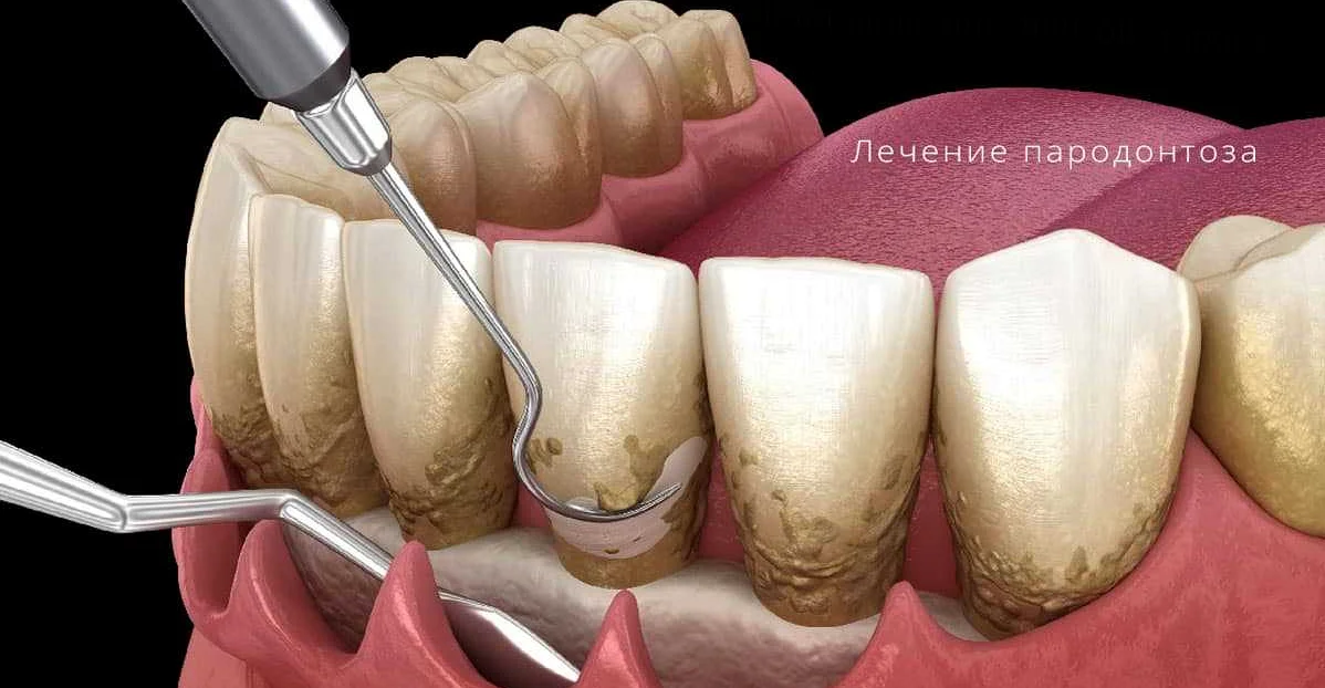 Преимущества регулярной профилактики пародонтоза через посещения стоматолога