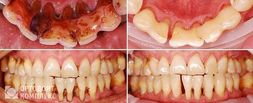 Регулярные посещения стоматолога - действенное средство против пародонтоза